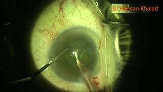 Phacoemulsification in Patient with Corneal Guttata [upl. by Nahsyar186]