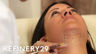 Kybella Double Chin Removal Treatment Up Close  Macro Beauty  Refinery29 [upl. by Jerome]