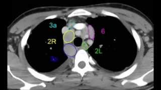 Les ganglions médiastinaux en scanner pour les internes [upl. by Simaj103]
