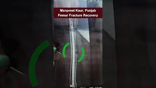 Femur Fracture Recovery  दो महीने में बहन जी खुद से चलने लगी doctor fracture shorts [upl. by Willey552]