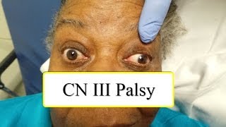 CN III Palsy [upl. by Lesna]