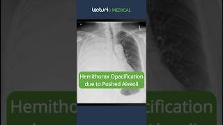 Hemithorax Opacification Pushed Alveoli Explained 🩺 ChestXray Radiology USMLE [upl. by Nnaeinahpets855]