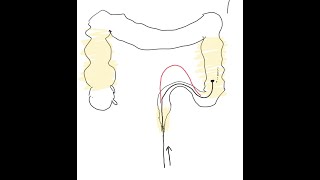 Colonoscopy Looping and Reducing Loops [upl. by Rustice612]