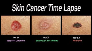 Skin Cancer Time Lapse Basal Cell Carcinoma Squamous Cell Carcinoma Melanoma [upl. by Nabalas231]