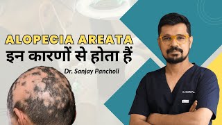 What causes Alopecia Areata in adults  hairfallsolutions  Alopecia awareness  alopecia [upl. by Phoebe]