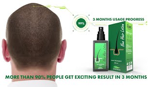 Green Wealth Neo Hair Lotion  3 Month Usage Progress [upl. by Palla423]