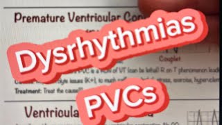 Dysrhythmias PVCs [upl. by Nadirehs]