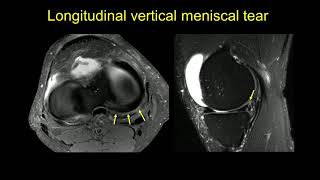 Imaging of the menisci [upl. by Arabel]