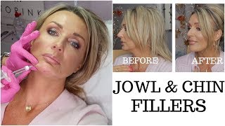 Jowls and Chin Fillers with Before And After Photos  my experience [upl. by Kari]