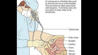 Video Cystoscopy Actual Procedure ENG SUB [upl. by Broder]