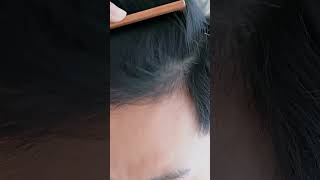 Does Saw Palmetto Help Hair Growth [upl. by O'Donoghue945]