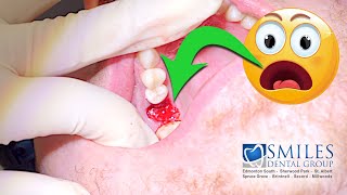 Live Surgical Extraction of INFECTED root canal tooth amp Bone Graft [upl. by Levine]