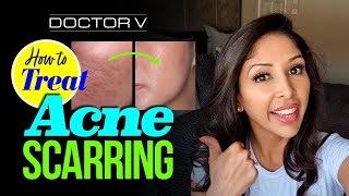 Doctor V  How To Treat Acne Scarring  Skin Of Colour  Brown Or Black Skin [upl. by Basia]