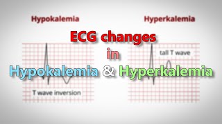 Hypokalemia and Hyperkalemia ECG changes [upl. by Nelon]