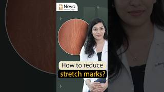 How to get rid of stretch marks  Dr Ravali Yalamanchili  Skin specialist in Hyderabad [upl. by Gerty]