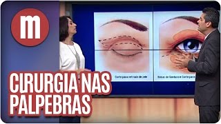 Mulheres  Saúde Cirurgia nas pálpebras 290316 [upl. by Bianka805]