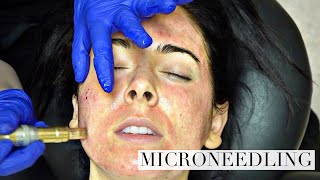 NIKKI GETS A NEW FACE Microneedling for acne scars BEFORE AND 6 MONTHS AFTER [upl. by Julide]