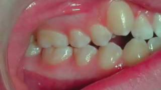 Invisalign Treatment Snaggle Tooth Correction [upl. by Vasileior518]