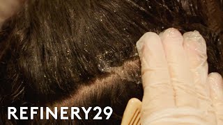 I Got A Scalp Facial To Treat Dandruff  Macro Beauty  Refinery29 [upl. by Shorter]