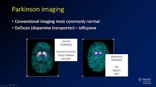 Neuroradiology board review lecture 1 neurodegenerative review [upl. by Laven448]