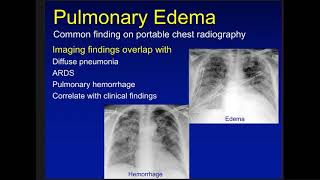 edema atelectasis and consoldiation [upl. by Ael]