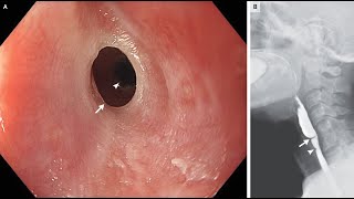 Plummer–Vinson Syndrom [upl. by Onurb]