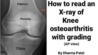 How to read knee joint Xray in knee osteoarthritis  Normal Knee X ray  Ortho X ray interpretation [upl. by Polard]