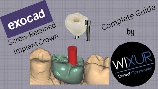 Exocad  ScrewRetained Implant Crown [upl. by Nnylak]