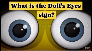 What is the Dolls eyes sign [upl. by Ahseina]