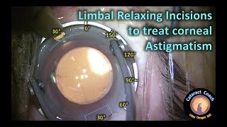 Limbal Relaxing Incisions to treat corneal astigmatism during cataract surgery [upl. by Ahsenroc]