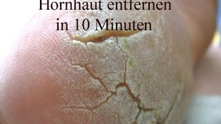 Hornhaut entfernen  Beste und schnellste Methode [upl. by Nagem]