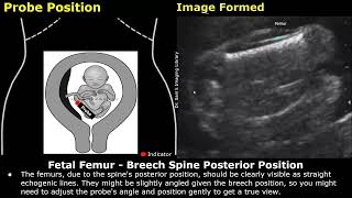 Fetal Femur Ultrasound Probe Positioning amp Image Formation  FL USG Scanning Technique amp Orientation [upl. by Laurentia188]