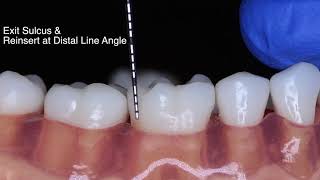 Periodontal Probe Basic Technique [upl. by Malachi124]