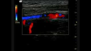 Arteritis de Takayasu compromiso carotideo vista por Eco Doppler [upl. by Yk]