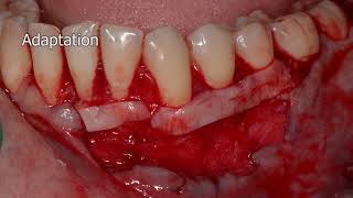 coronally advanced envelope flap and CTG for Miller class II recession treatment [upl. by Ydassac]