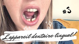 Ma chirurgie Maxillofaciale  Vlog 3  Appareil dentaire lingual [upl. by Leisam311]