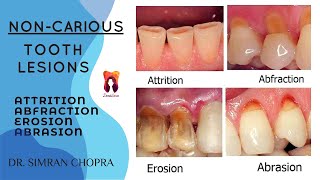 Non Carious Tooth Lesions l Attrition Abrasion Abfraction Erosion l Operative Dentistry [upl. by Annayar199]