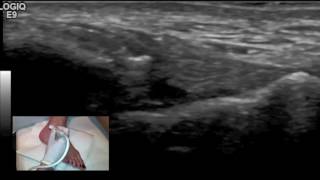 Ultrasound tutorial  Imaging of the Anterior Talofibular Ligament [upl. by Isbella]