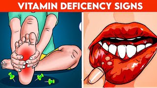 7 Hidden Signs of Vitamin Deficiency You Need to Know [upl. by Sven]