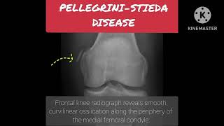 Pellegrini Stieda disease [upl. by Behre]