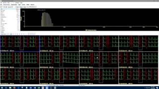 1 Introduction to Holter Analysis NEM [upl. by Collyer]