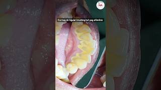 Is dental scaling harmful dentalscaling toothcleaning [upl. by Carroll345]