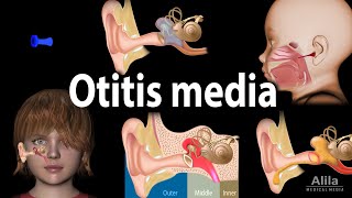 Otitis Media Anatomy Pathophysiology Risk Factors Types of OM Symptoms and Treatment Animation [upl. by Dave]