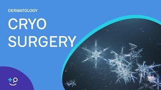 Cryo Surgery Procedure Freezing [upl. by Norihs]