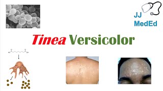 “Fungal Skin Infection of Many Colors” Tinea Versicolor  Pathogenesis Symptoms and Treatment [upl. by Yand]