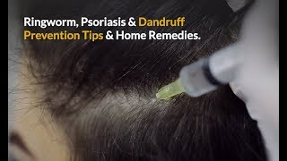 Hair And Scalp Diseases amp Disorders Causing Dandruff amp Hair Loss How To Prevent And Treat Them [upl. by Yemane596]