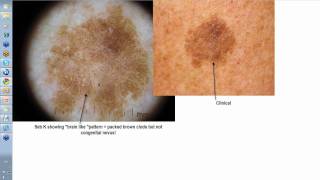 Dermoscopy Made Simple  Seborrhoeic Keratoses [upl. by Sitnik]