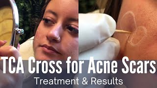 TCA CROSS for acne scars [upl. by Rebna575]