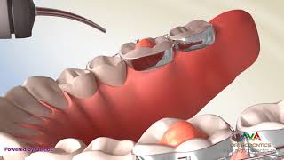 Posterior Bite Block  Orthodontic Treatment [upl. by Thilda]