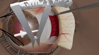 Strabismus surgery Resection [upl. by Eerrehc649]